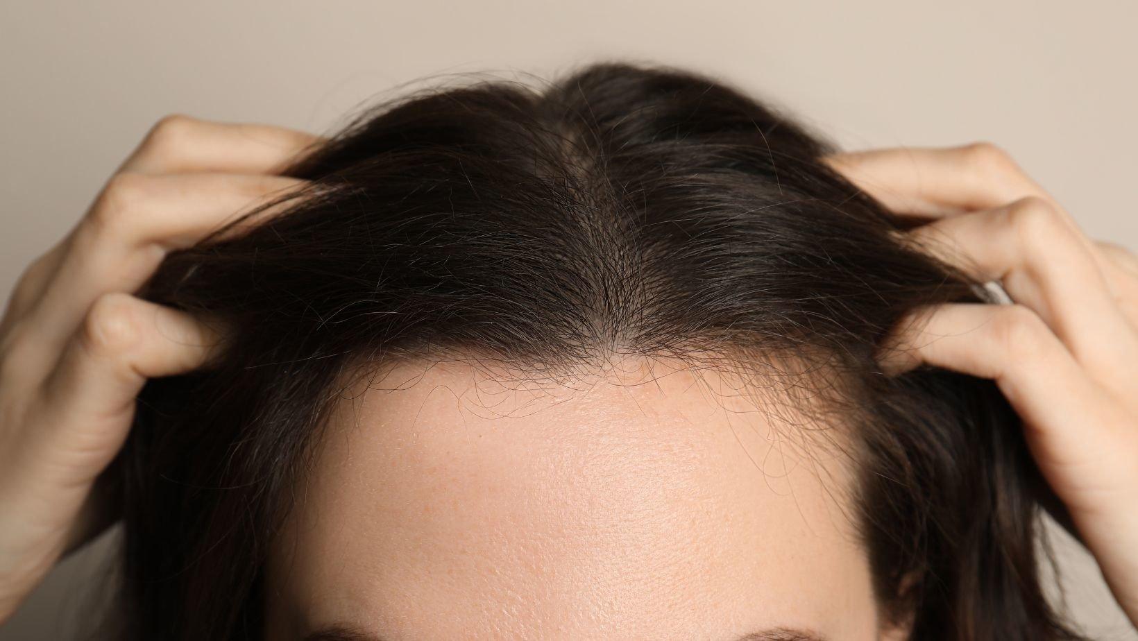 Everything You Need to Know About Female Pattern Baldness - Actiiv Hair Science