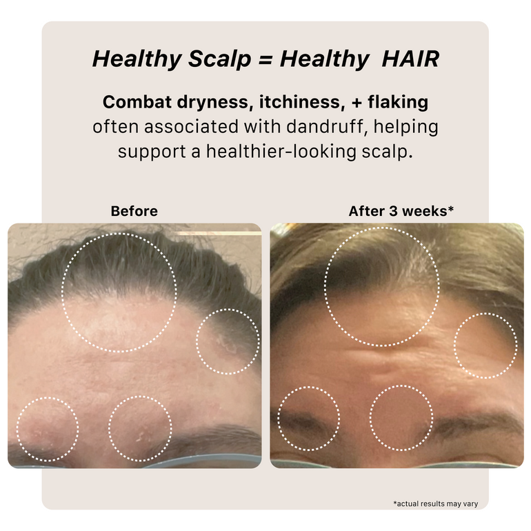 Remedy Dandruff Shampoo Results combatitng dry itchy scalp