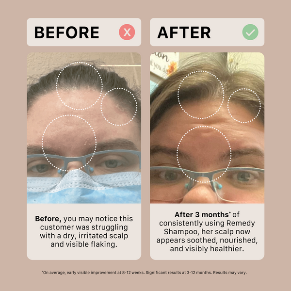 Before and after comparison of a person's scalp with visible flaking, using Remedy dandruff Shampoo.