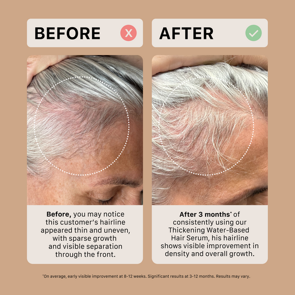 Before and after comparison of a person's hairline using a ACTIIV oil-based thickening hair serum.