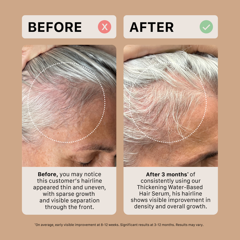 Before and after comparison of a person's hairline using a ACTIIV oil-based thickening hair serum.