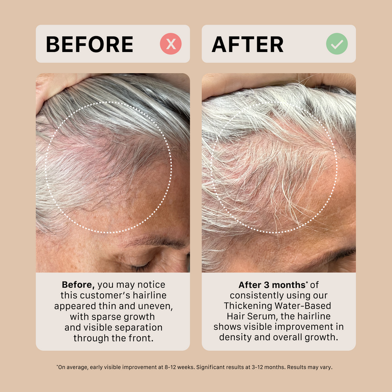 Before and after comparison of a person's hairline using a water-based hair serum.