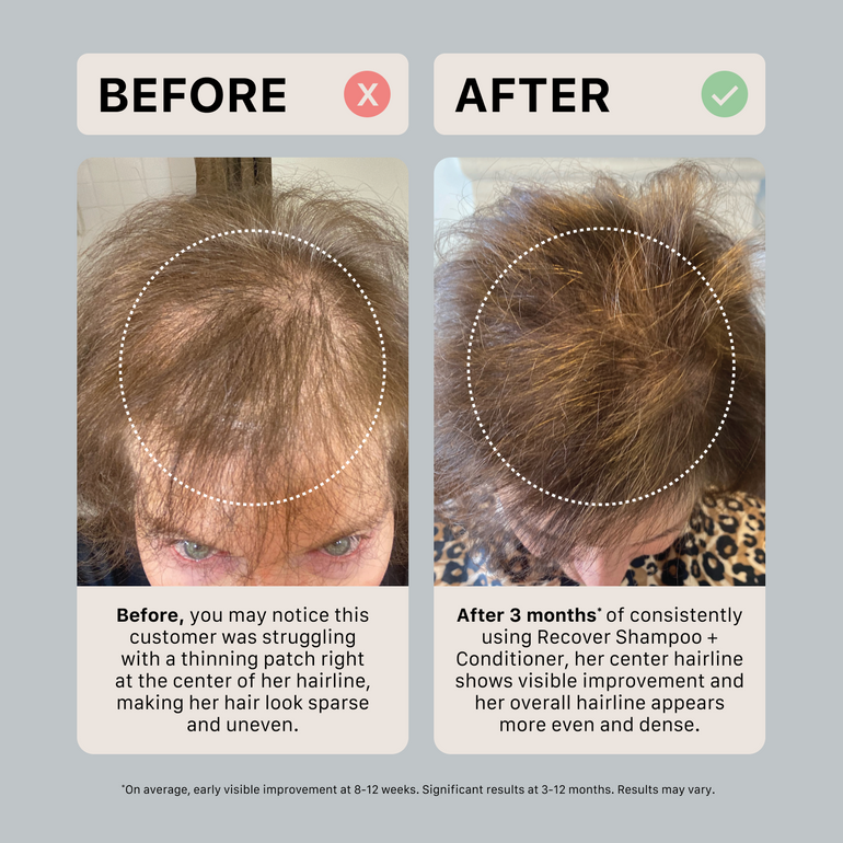 Before and after comparison of a person's hairline with text indicating improvement over 3 months using Recover Shampoo + Conditioner.