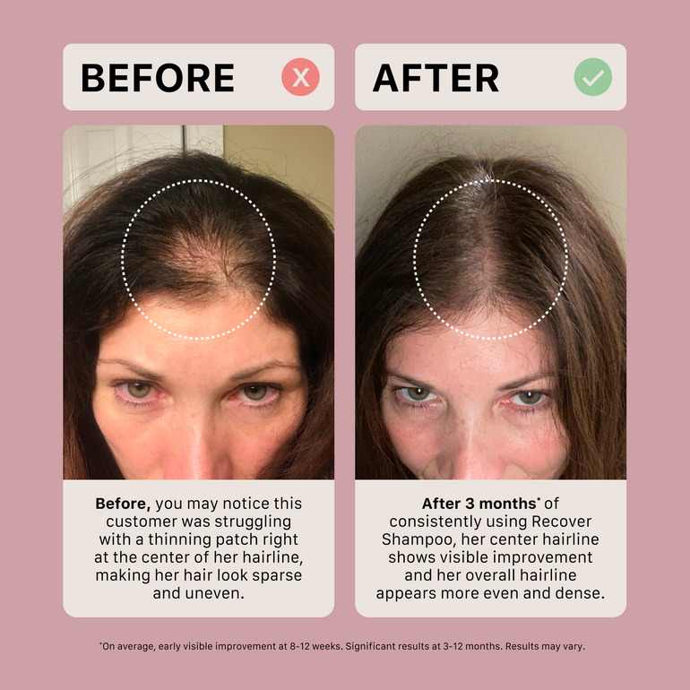 Before and after comparison of a woman's hairline improvement using Recover Shampoo on a pink background.