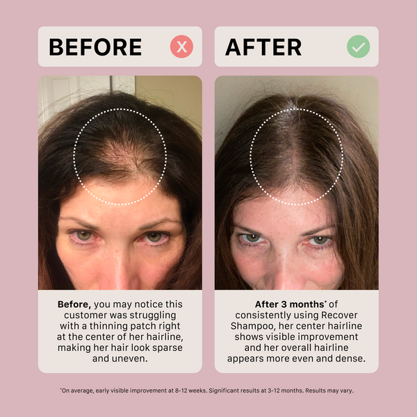 Before and after comparison of a woman's hairline improvement using actiiv recover women's travel duo on a pink background.