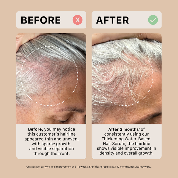 Before and after comparison of a person's hairline using ACTIIV water-based hair serum.