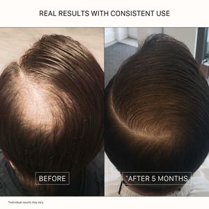 Before and after hair thickening transformation with ACTIIV Recover Men shampoo after 5 months of consistent use
