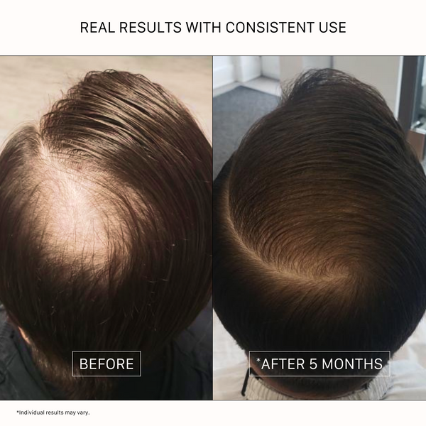 Before and after hair thickening transformation with ACTIIV Recover Men shampoo after 5 months of consistent use