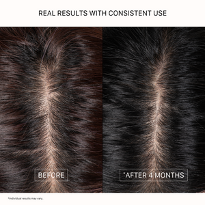 ACTIIV Thickening Hair Serum before-and-after results showing the appearance of fuller, denser-looking hair after 4 months of consistent use; individual results may vary.