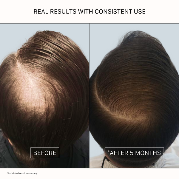 ACTIIV Recover Thickening Shampoo Treatment for Men before and after results showing visibly thicker, fuller-looking hair and reduced appearance of thinning with consistent scalp care routine after 5 months of use.