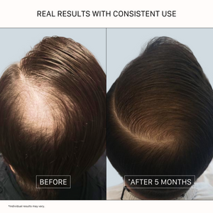 Before and after results showing visibly fuller-looking hair and reduced scalp visibility after 5 months of consistent use of ACTIIV Recover Thickening Shampoo and Conditioner for men.