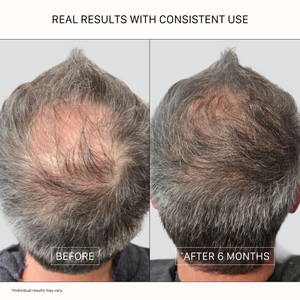 Top-of-scalp before and after comparison demonstrating healthier-looking, visibly denser hair after 6 months of using ACTIIV Recover Thickening Shampoo Treatment for men.