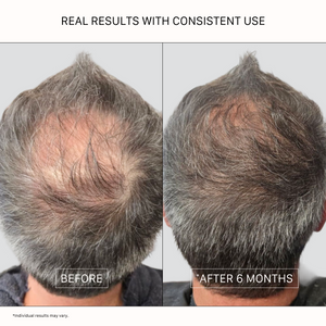 ACTIIV Recover Thickening Shampoo Treatment for Men before and after results showing visibly fuller-looking hair, improved scalp coverage, and reduced appearance of thinning after 6 months of consistent use. Plant-based thickening shampoo for men with thinning or fine hair.