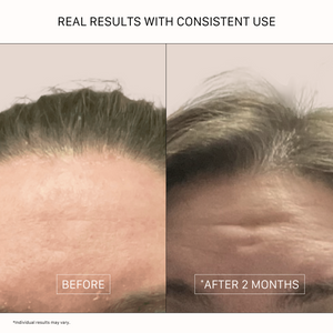 ACTIIV Remedy Dandruff Shampoo before and after results showing reduced scalp flakes, healthier-looking hairline, and thicker-looking hair after consistent scalp care use