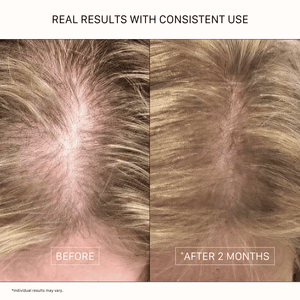 Hair density before and after showing a woman’s blonde scalp and fuller-looking hair after two months of consistent ACTIIV hair care use. Individual results may vary.