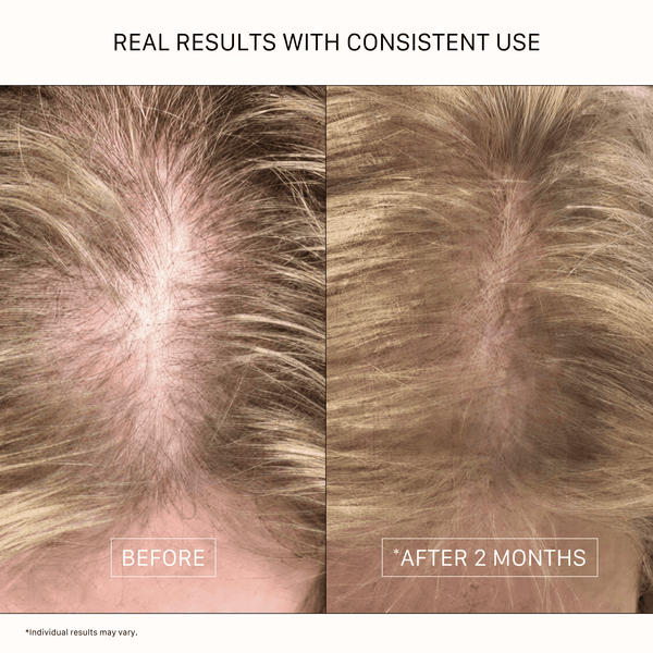 Women’s hair density before and after showing the appearance of fuller-looking blonde hair and reduced scalp visibility after two months of consistent use. Individual results may vary.
