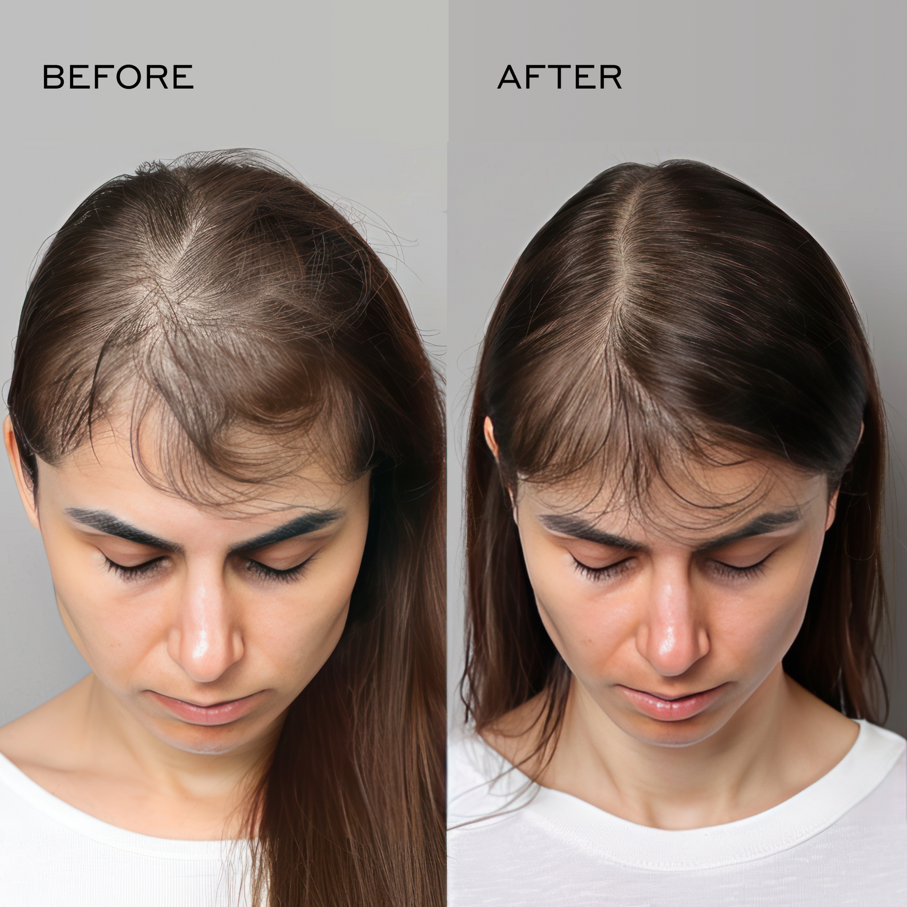 Before and after comparison showing a woman’s thinning hairline at the part before use and a more even, fuller-looking appearance after consistent use of Actiiv Recover Thickening Shampoo.