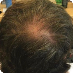 After image showing improvement in the appearance of thinning hair at the crown