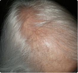 Before image showing fine, sparse-looking hair and visible scalp at the crown prior to using ACTIIV scalp-focused hair care