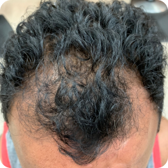Before image showing the appearance of thinning hair at the front hairline