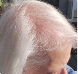 After image showing the appearance of increased hair fullness and improved visual density after continued use of ACTIIV thickening routine