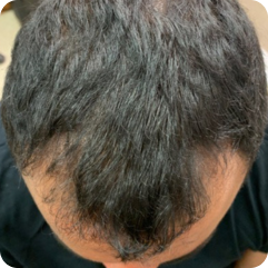 After image showing improved appearance of thinning hair at the front hairline