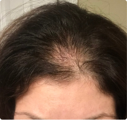 Before image showing visible scalp and thinning appearance at the hairline prior to using ACTIIV thickening hair care routine
