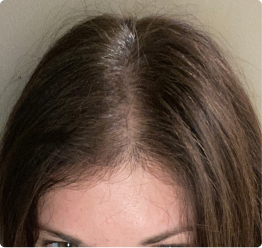 After image showing the appearance of fuller-looking hair and reduced scalp visibility following consistent use of ACTIIV thickening products