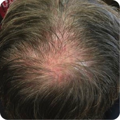 Before images showing the appearance of thinning hair at the crown