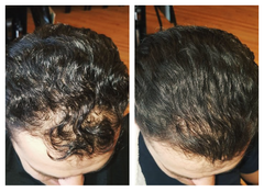 Before and After of anti-hair loss and thinning results on man using Actiiv Recover Hair Loss Shampoo and Conditioner for Men for 4 weeks
