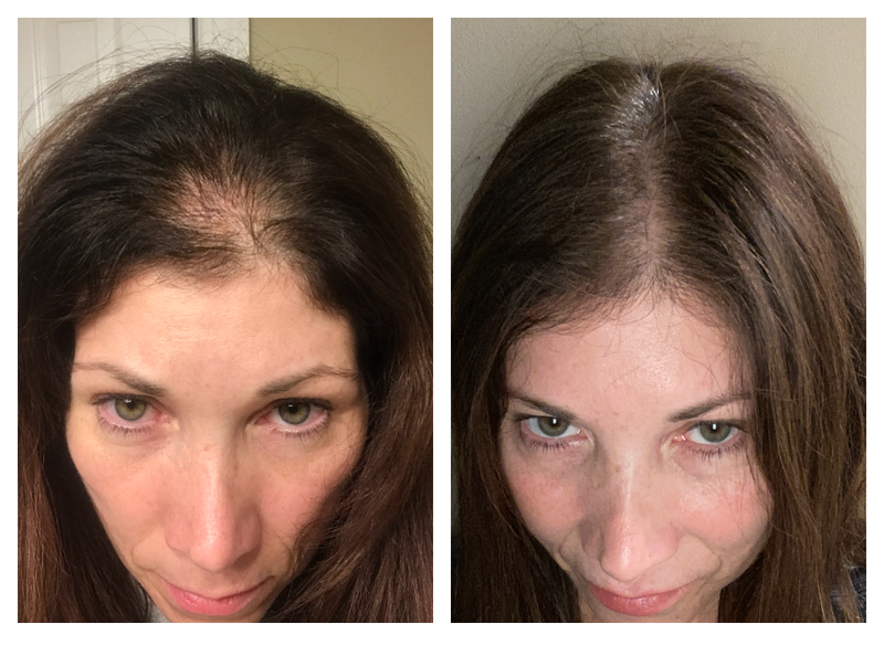 Before and After of anti-hair loss and thinning results on man using Actiiv Recover Hair Loss Shampoo and Conditioner for Women for 2 Months