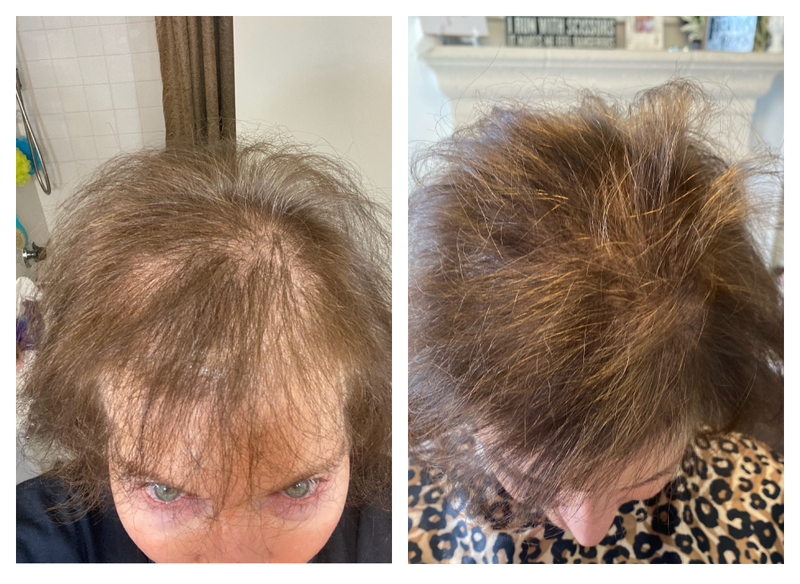 Before and After of anti-hair loss and thinning results on man using Actiiv Recover Hair Loss Shampoo and Conditioner for Women for 9 Weeks