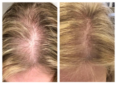Before and After of anti-hair loss and thinning results on man using Actiiv Recover Hair Loss Shampoo and Conditioner for Women for 8 weeks