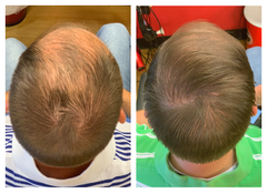 Before and After of anti-hair loss and thinning results on man using Actiiv Recover Hair Loss Shampoo and Conditioner for Men for 13 weeks