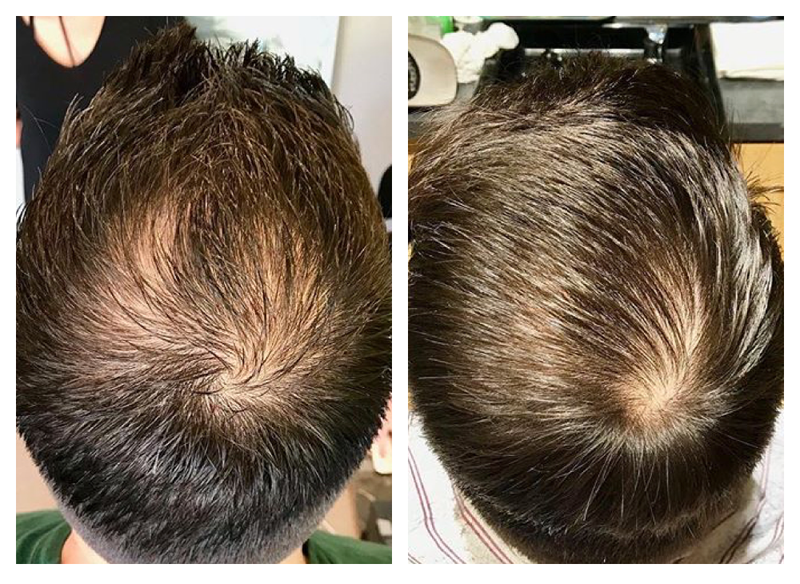 Before and After of anti-hair loss and thinning results on man using Actiiv Recover Hair Loss Shampoo and Conditioner for Men for 12 weeks