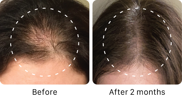 Before and after comparison of hair growth on a person's head with a white dashed line indicating the area of interest.