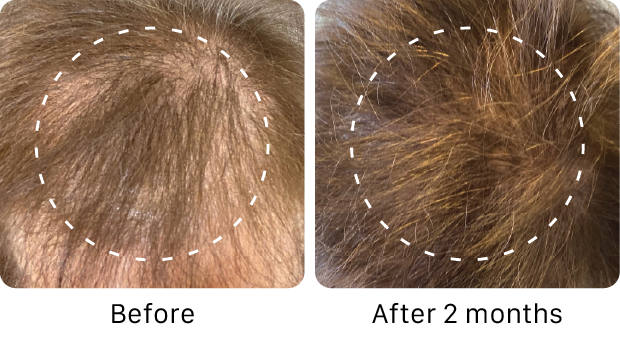 Before and after comparison of hair growth on a scalp with white dashed lines.