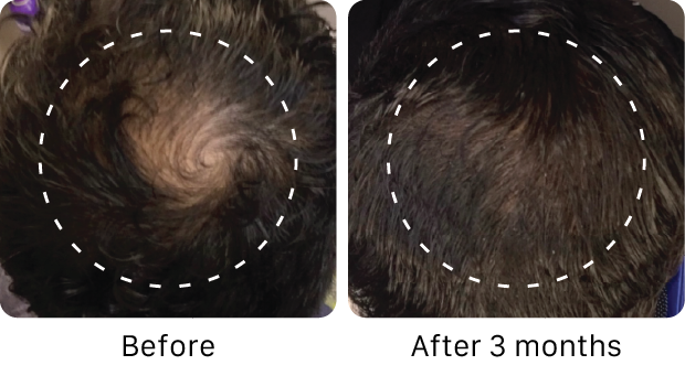 Before and after comparison of hair thickening on a scalp with a white dashed line.