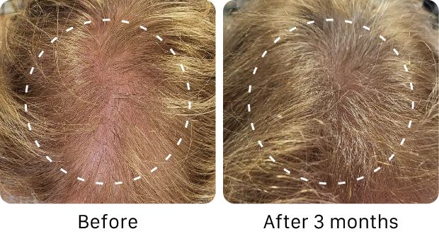 Before and after comparison of hair growth on a scalp with white dashed lines.