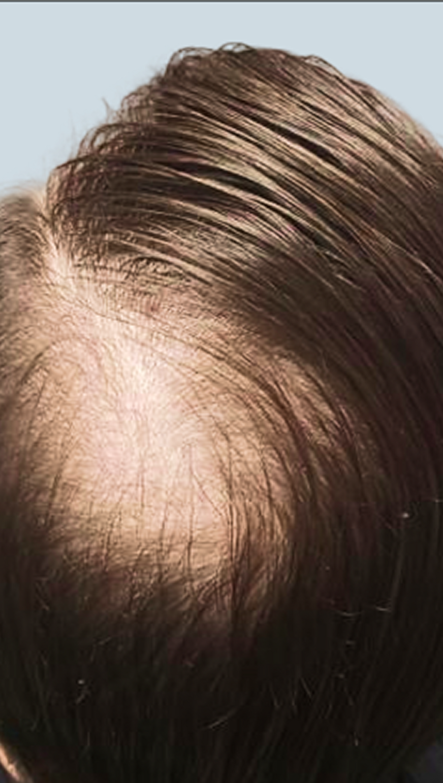 Before photo - scalp with visible thinning