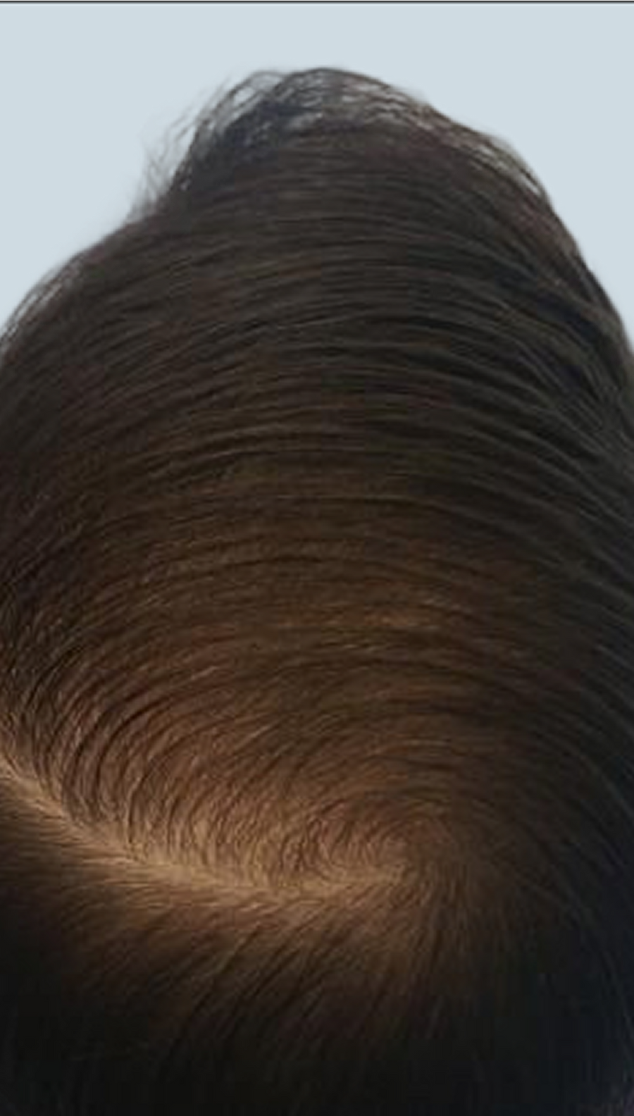 After photo - scalp with fuller-looking hair