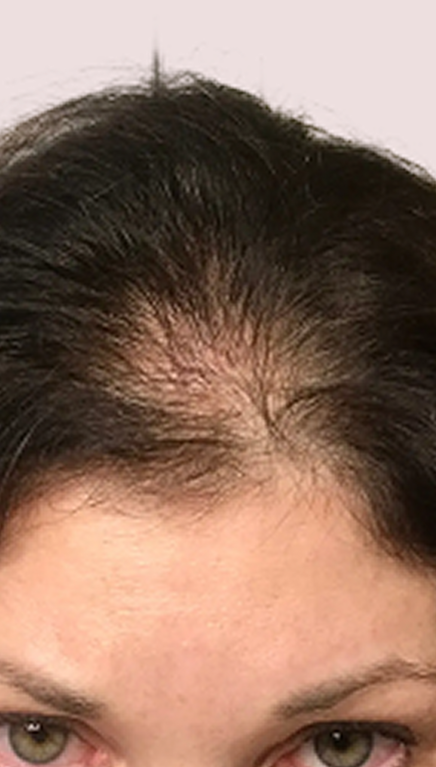 Before photo - scalp with visible thinning