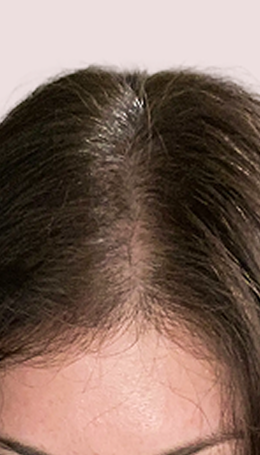 After photo - scalp with fuller-looking hair
