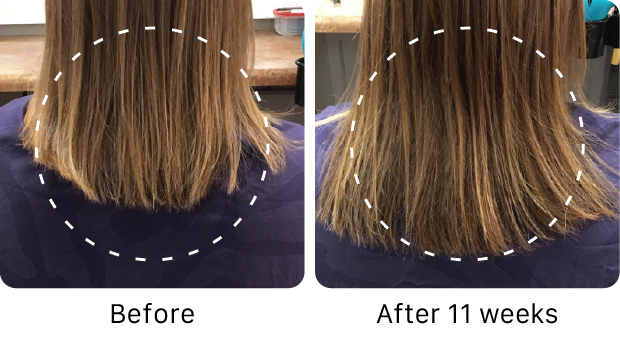 Before and after comparison of hair growth on a person wearing a purple shirt.