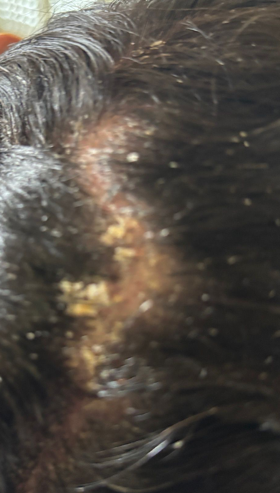Before photo - scalp with visible flaking