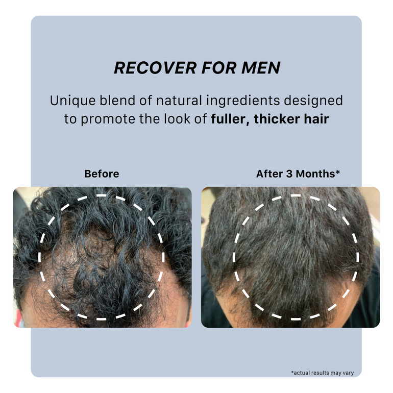 recover men's results showing thicker, fuller hair