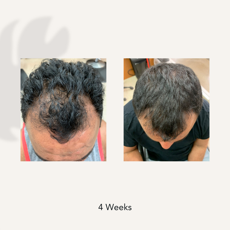 4 Weeks before and after showing dramatically reduced hair thinning and hair loss from using Actiiv Recover Thickening Shampoo for Men