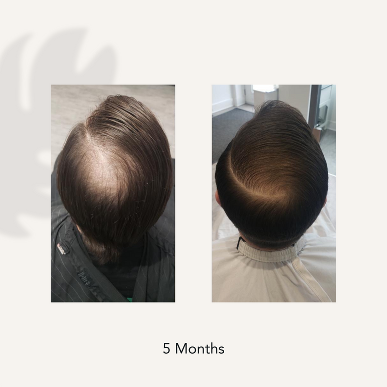 5 months before and after showing dramatic decrease in hair loss and thinning from using Recover Thickening Shampoo for Men and Recover Thickening Conditioner