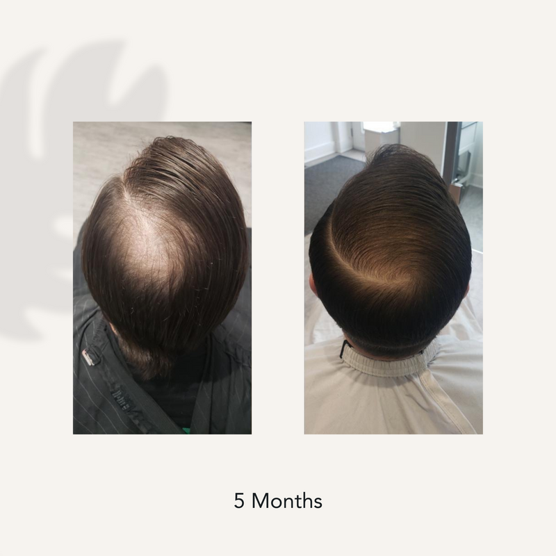 5 Months before and after showing dramatically reduced hair thinning and hair loss from using Actiiv Recover Thickening Shampoo for Men