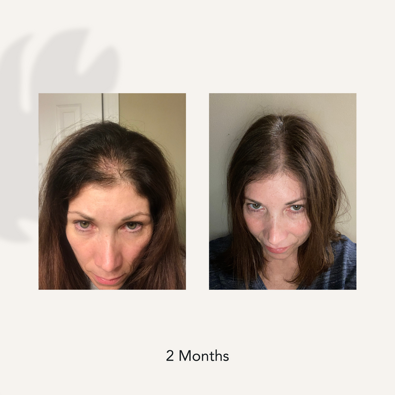 2 Month before and after photo showing dramatically reduced hair loss and thinning on customer who used Actiiv Recover Women's Hair Thickening products